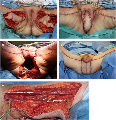 Reconstruction of Perineal Defects: A Comparison of the Myocutaneous Gracilis and the Gluteal Fold Flap in Interdisciplinary Anorectal Tumor Resection